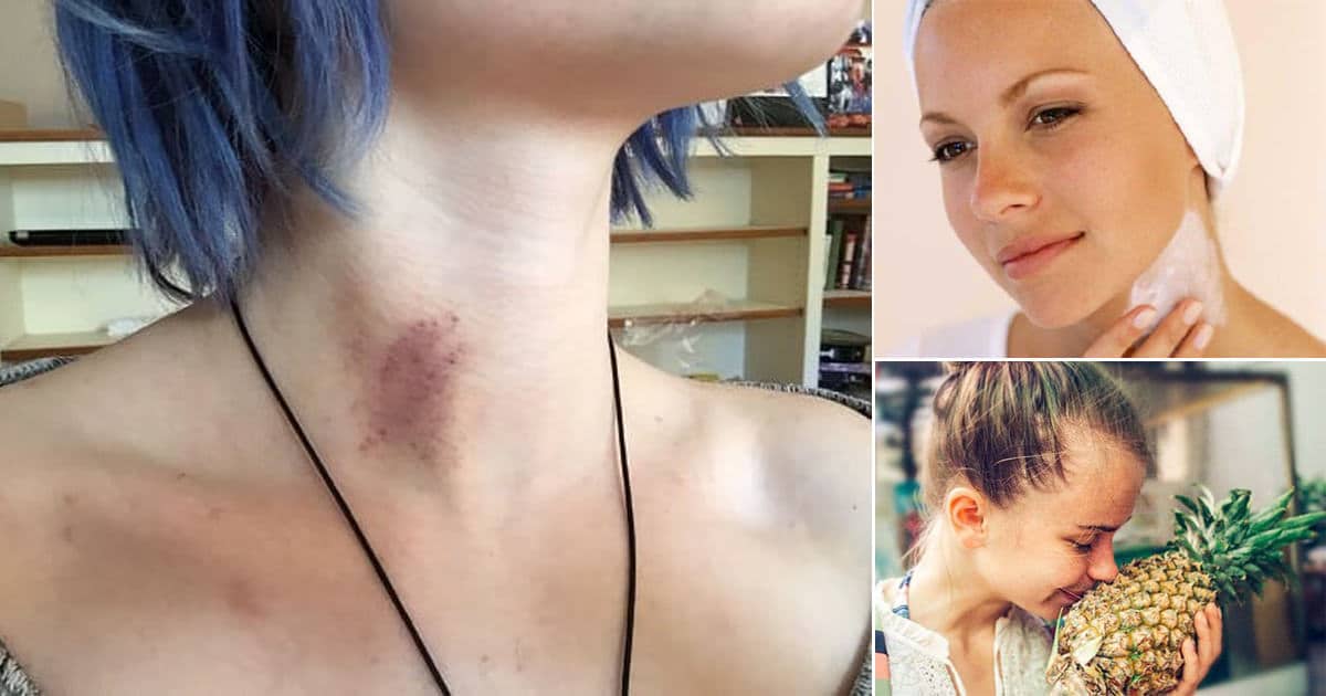 How to Remove a Hickey Types, How to Get Rid, & More ⋆