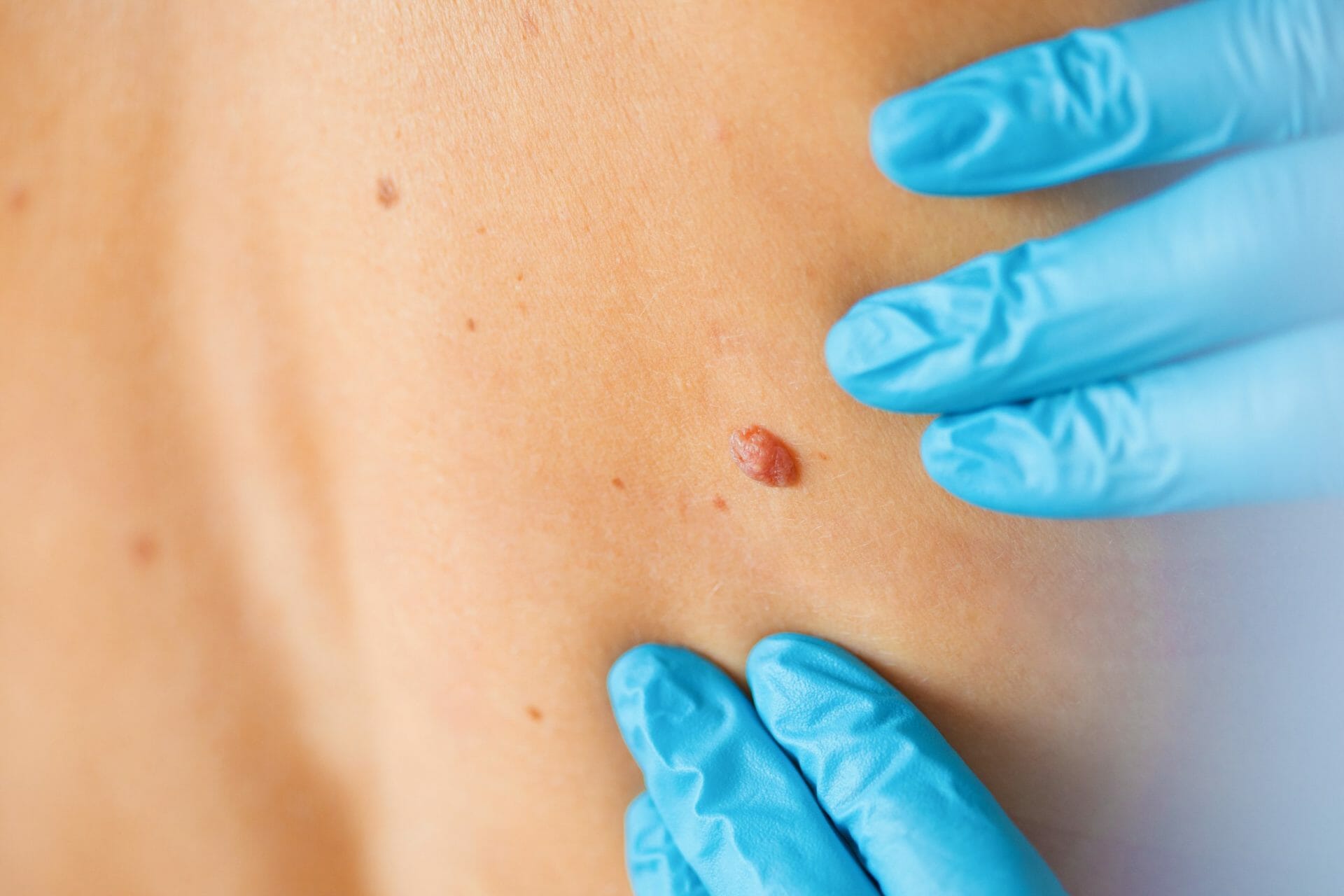 How to Check Your Moles Bristol Plastic Surgery