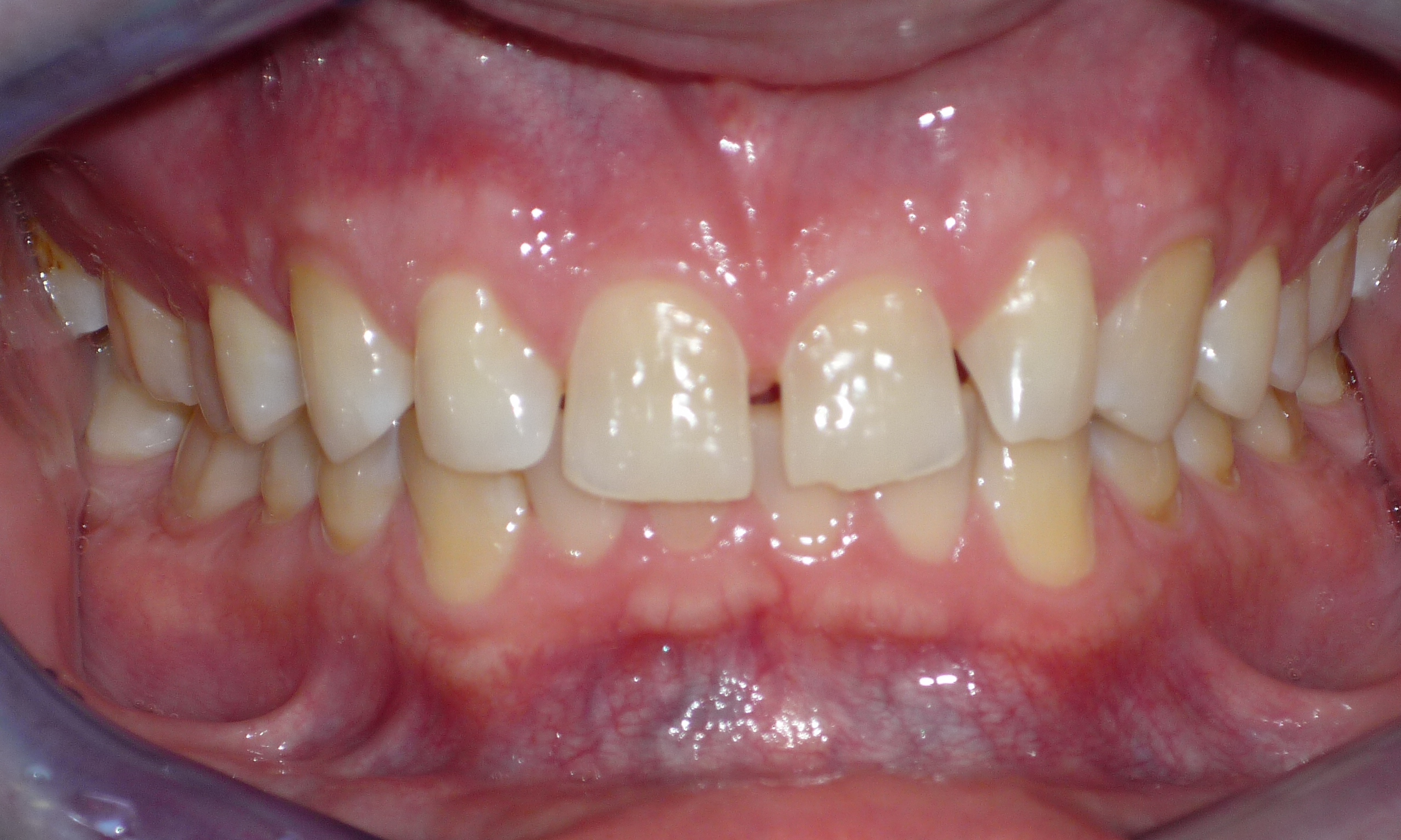 Smile before Porcelain Veneers Britt Dental Center Raleigh, NC Dentist