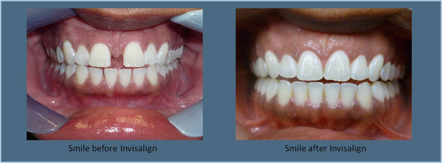 Invisalign Britt Dental Center Raleigh, NC DentistBritt Dental