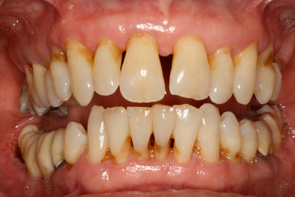 Periodontal Disease Britten Perio
