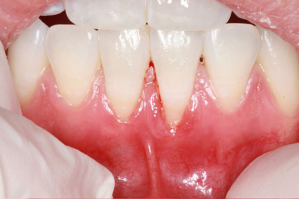 Before & After Gallery Britten Perio