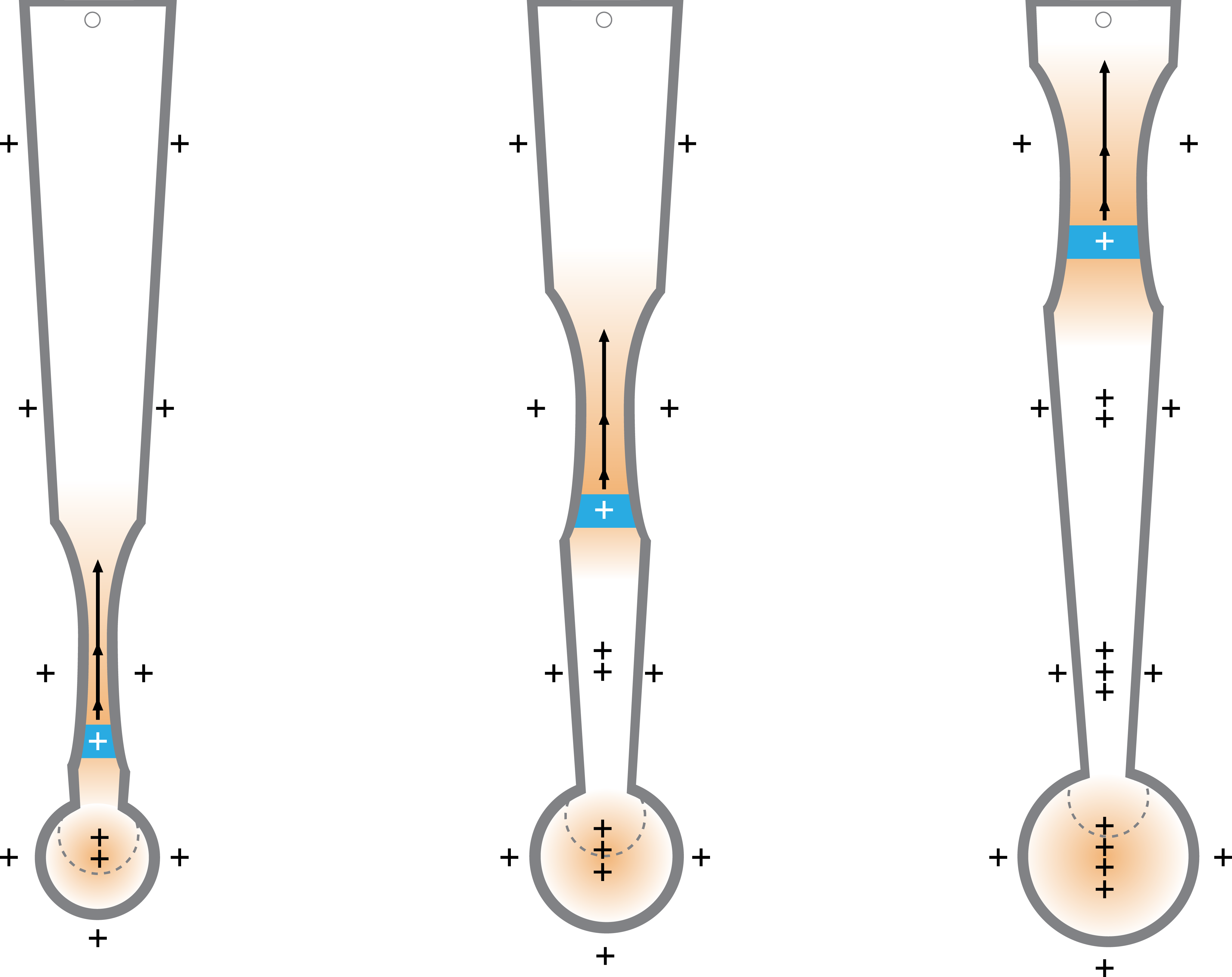 The active cycle of breathing technique Bronchiectasis
