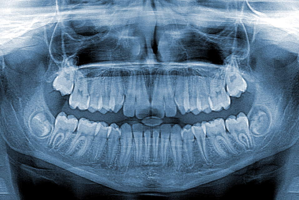Low Radiation Digital XRays Bronson Family Dentistry