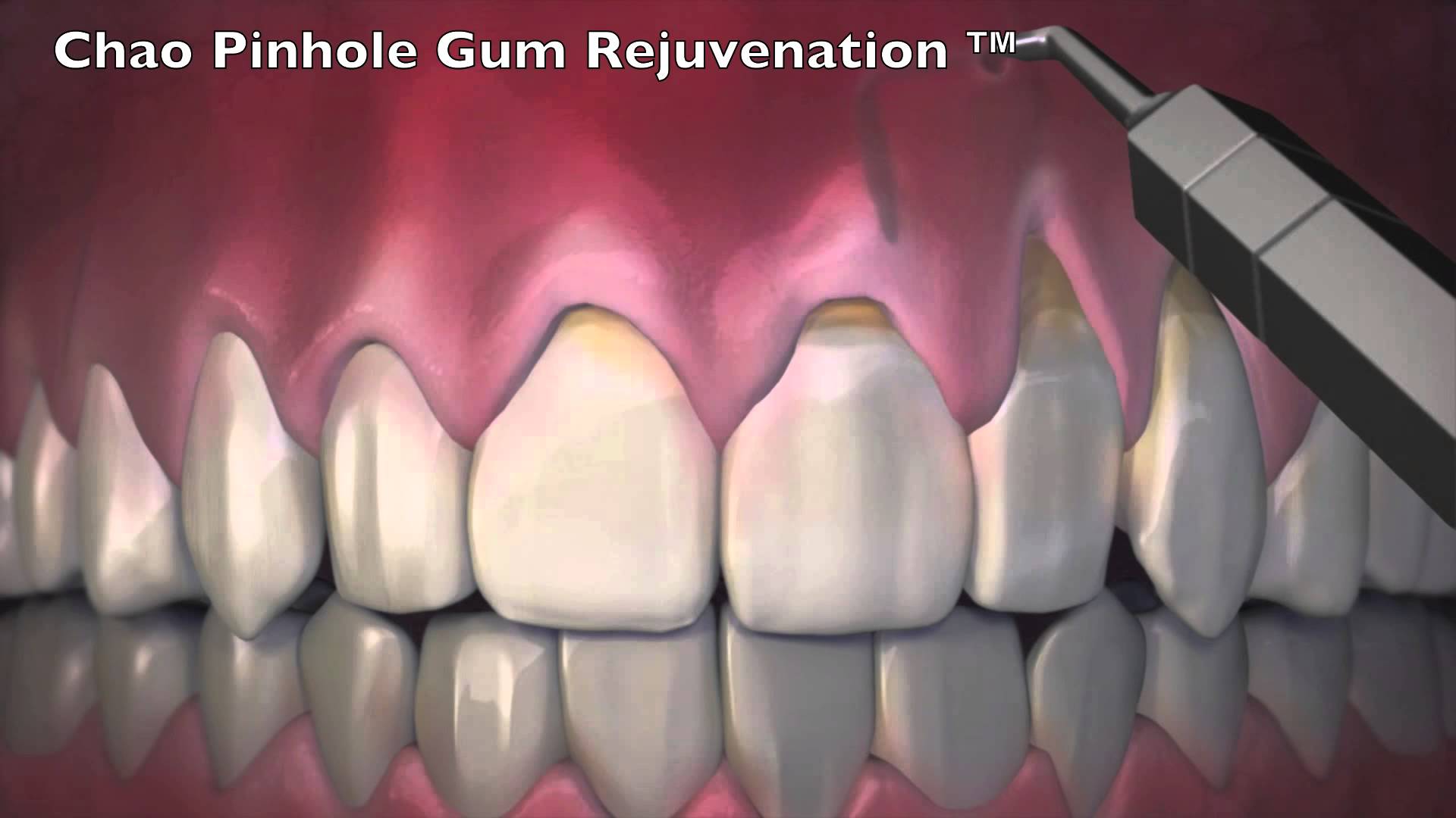 Pinhole SurgeryBronte Village Dental is your stop for your dental needs