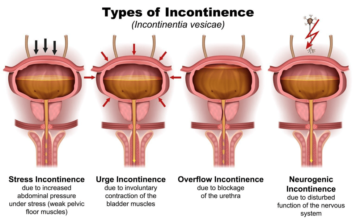 The Link Between Pelvic Floor Physical Therapy and Urinary Incontinence