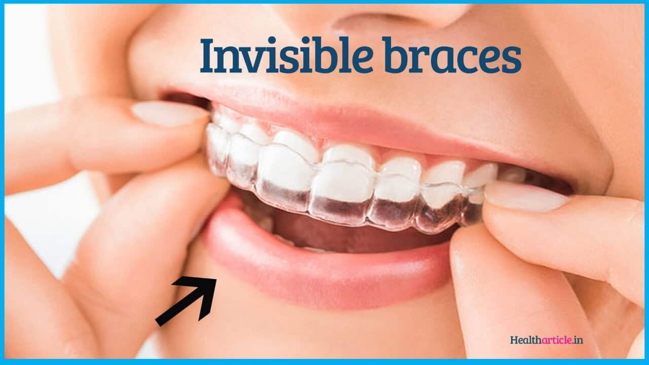 Invisible Braces cost, advantages and disadvantages