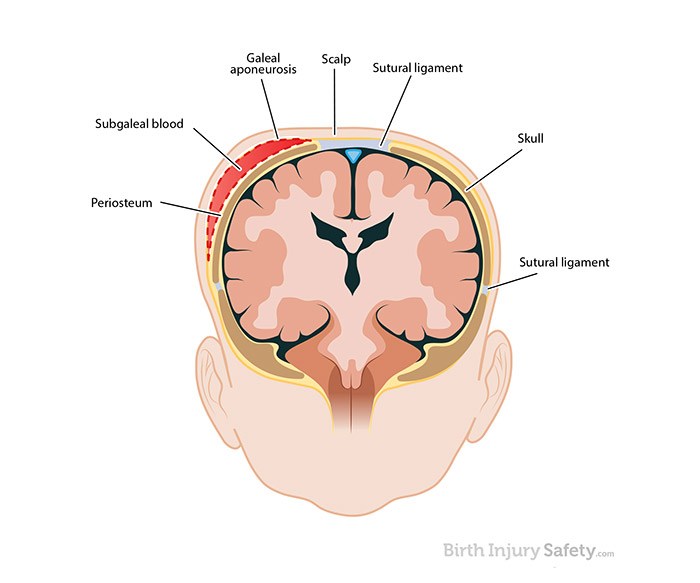 Vacuum Delivery Complications