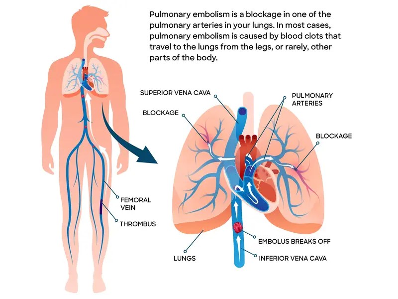 Embolia pulmonar Baylor Scott & White Health