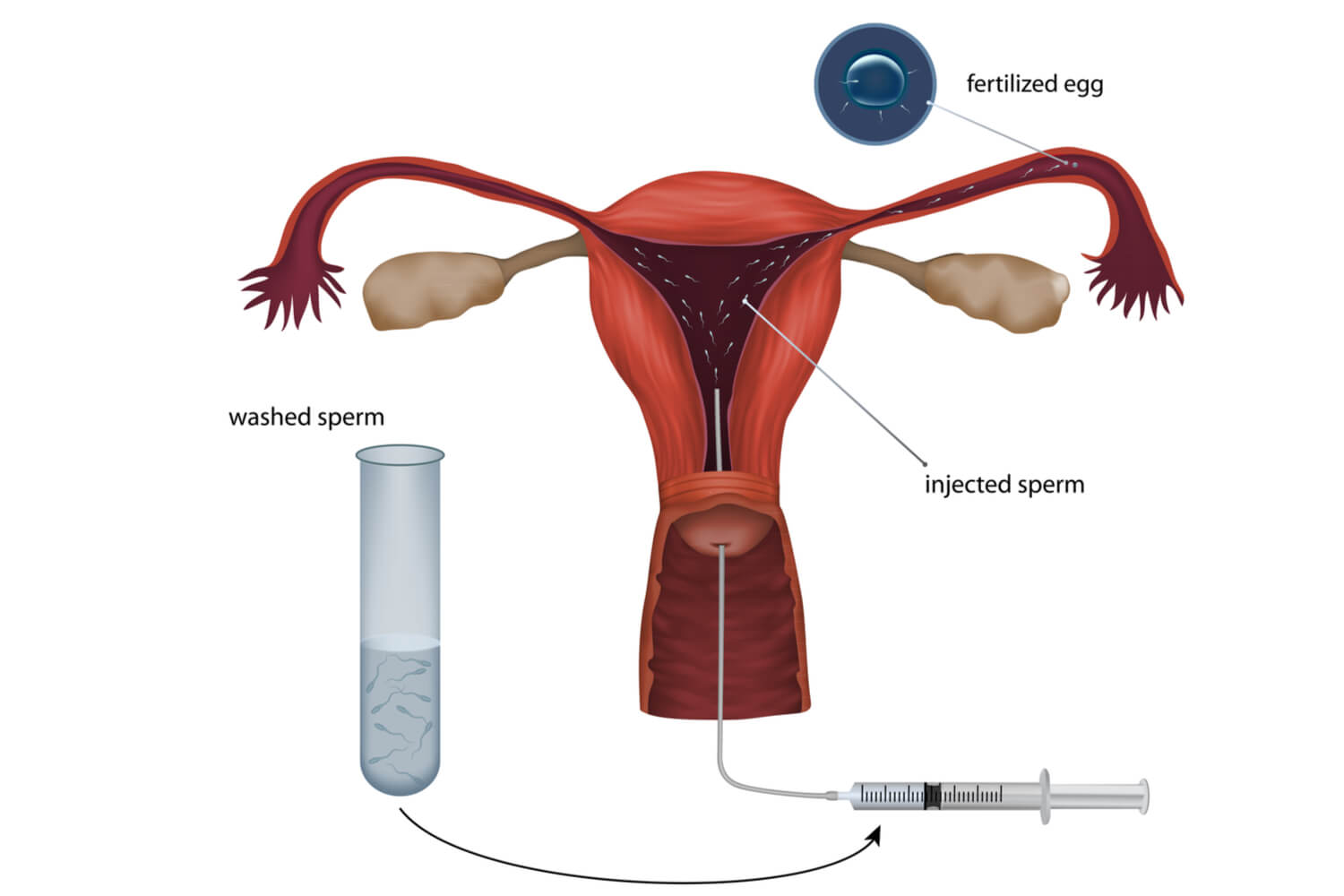 Artificial Insemination Process, Pros and Cons Being The Parent