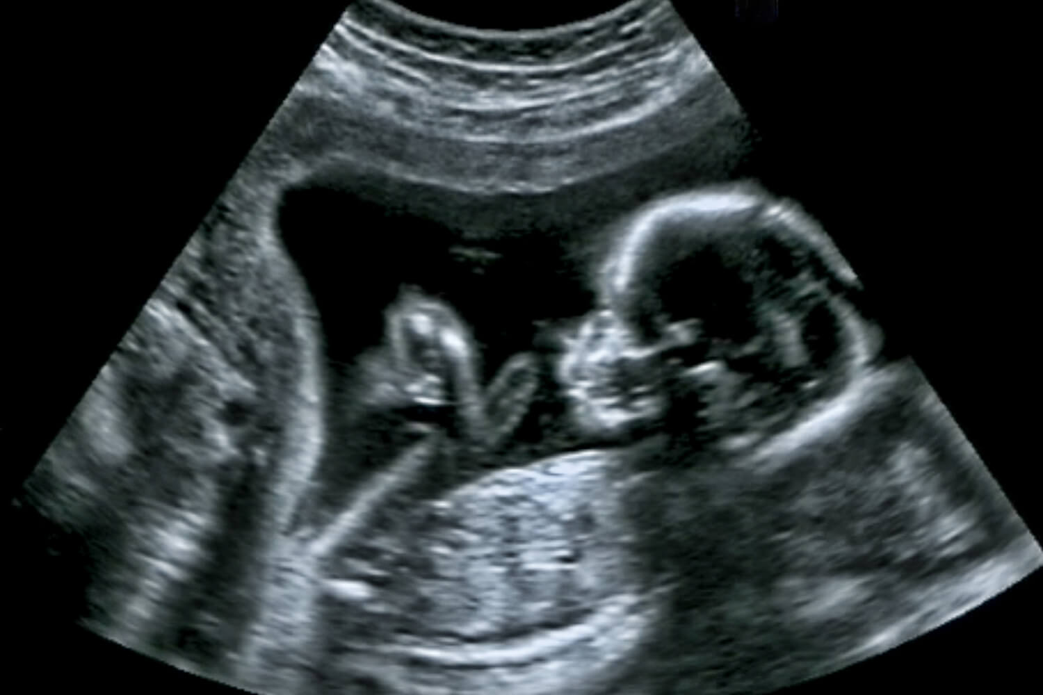 TIFFA Scan in Pregnancy Why is it Important, Preparations, Procedure