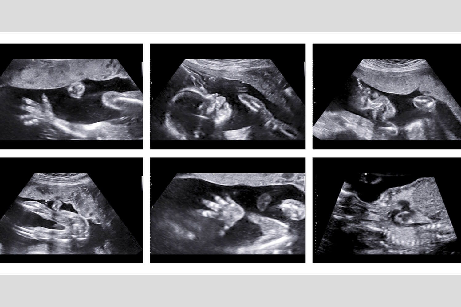 TIFFA Scan in Pregnancy Why is it Important, Preparations, Procedure