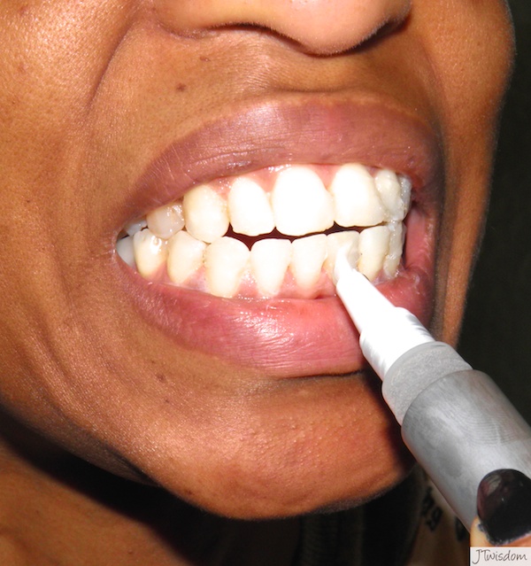 Smile Brilliant Teeth Whiting Gel Application System Bubbling with