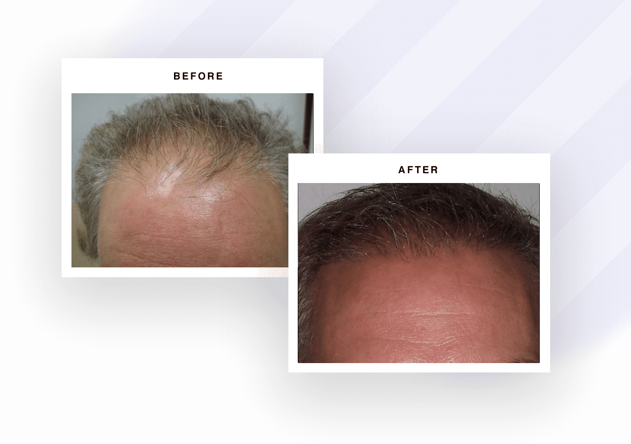 How About a Full Head of Hair in the New Year? Bubolo Medical