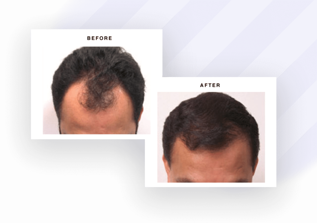 Hair Restoration Archives Bubolo Medical