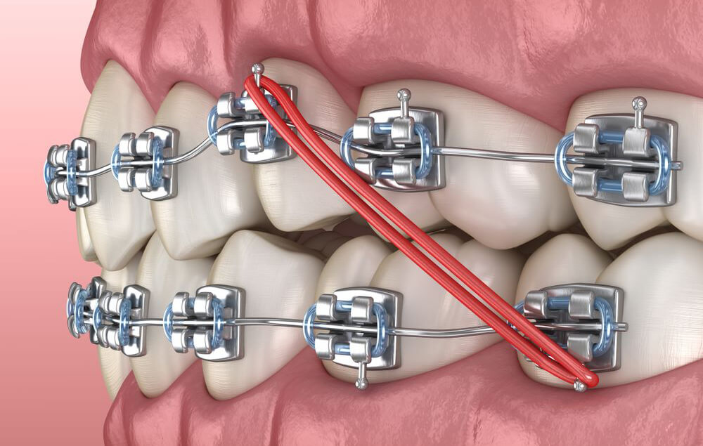 Ortodoncia archivos Página 3 de 4 Bucco