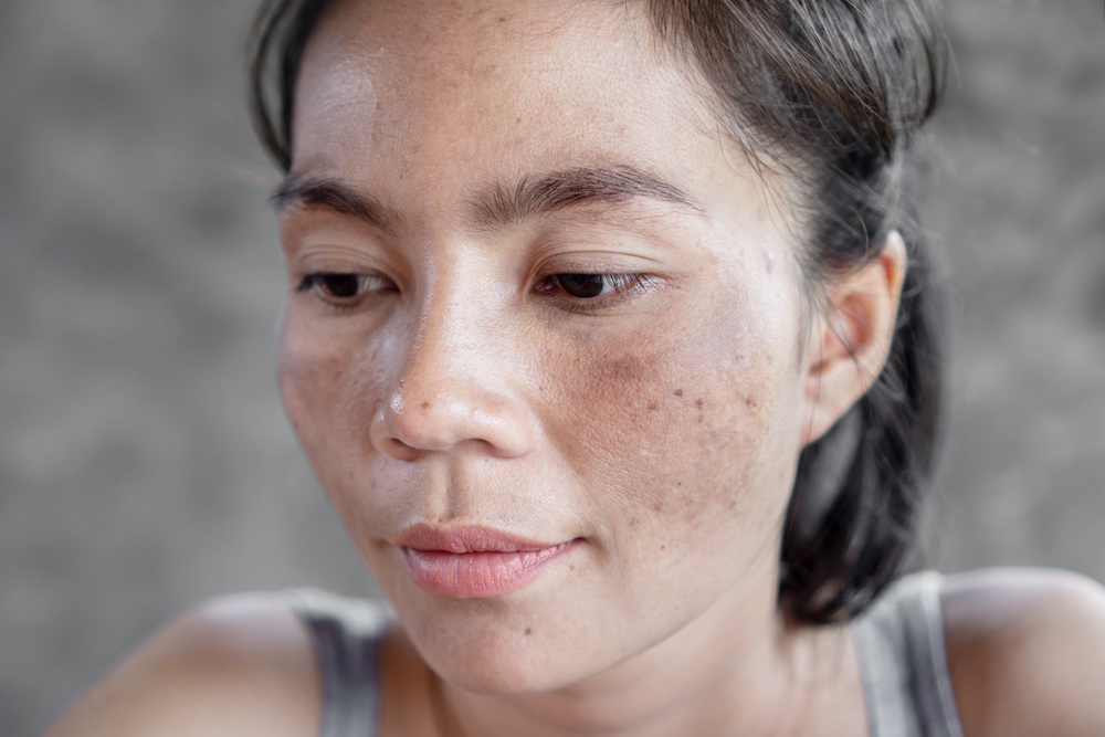 Melasma 101 What You Need to Know Buckhead Dermatology