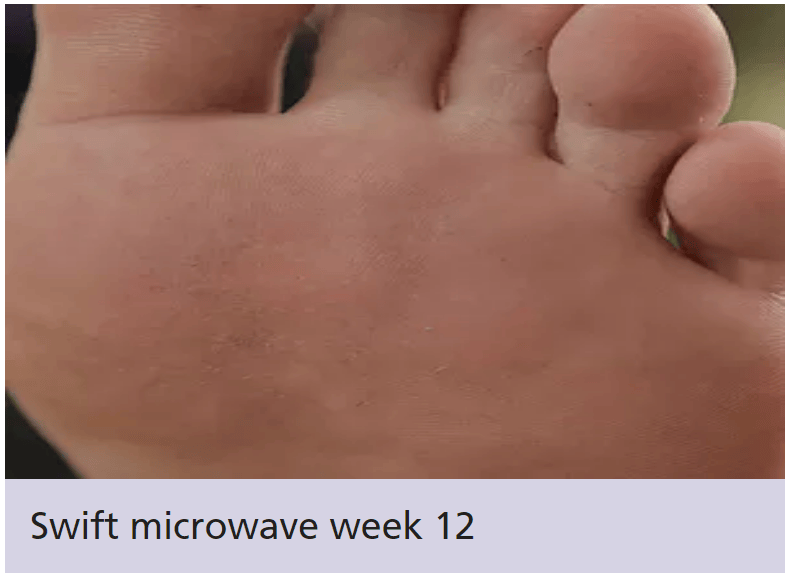 Swift Machine Best Podiatry and Chiropody Treatment in Amersham
