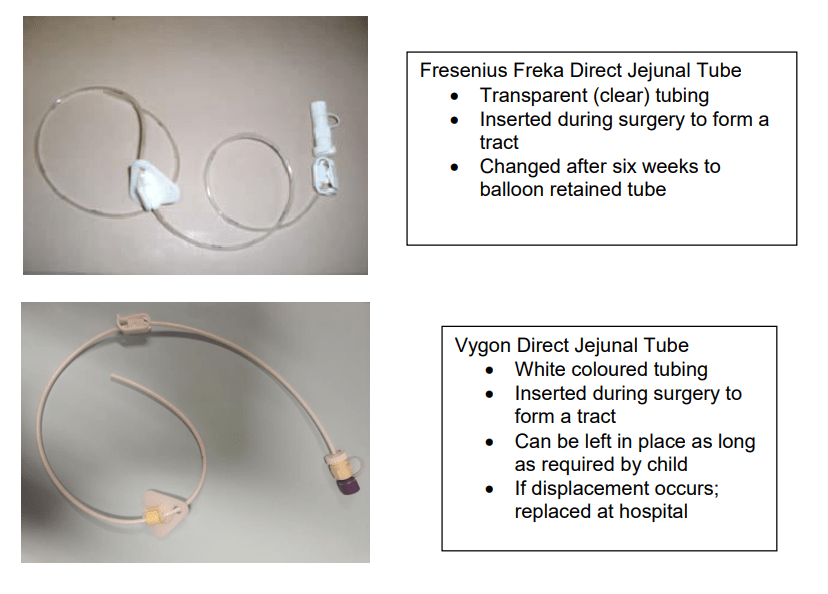 Direct (Surgically placed) Jejunostomy tube – information for parents