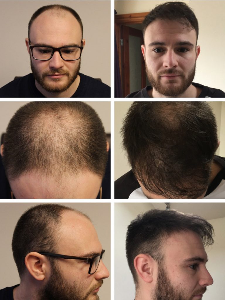 Hair transplant results Before and after images 1500 / 2000 / 2500 Grafts