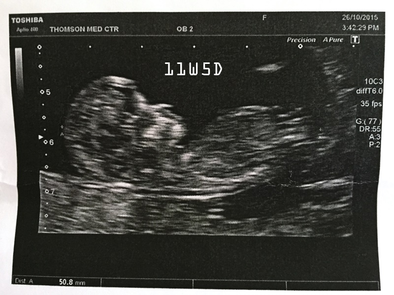 Pregnancy: The Second Trimester - Harmony Test And Gender Reveal! ⋆ Budgetpantry | Singapore Mummy Blog On Food, Recipe & Baby