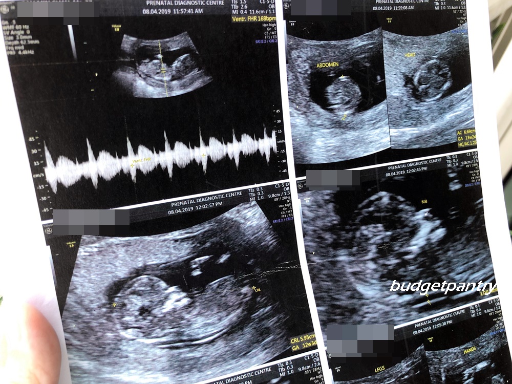 Pregnancy 2 The second trimester harmony test, NT scans and gender
