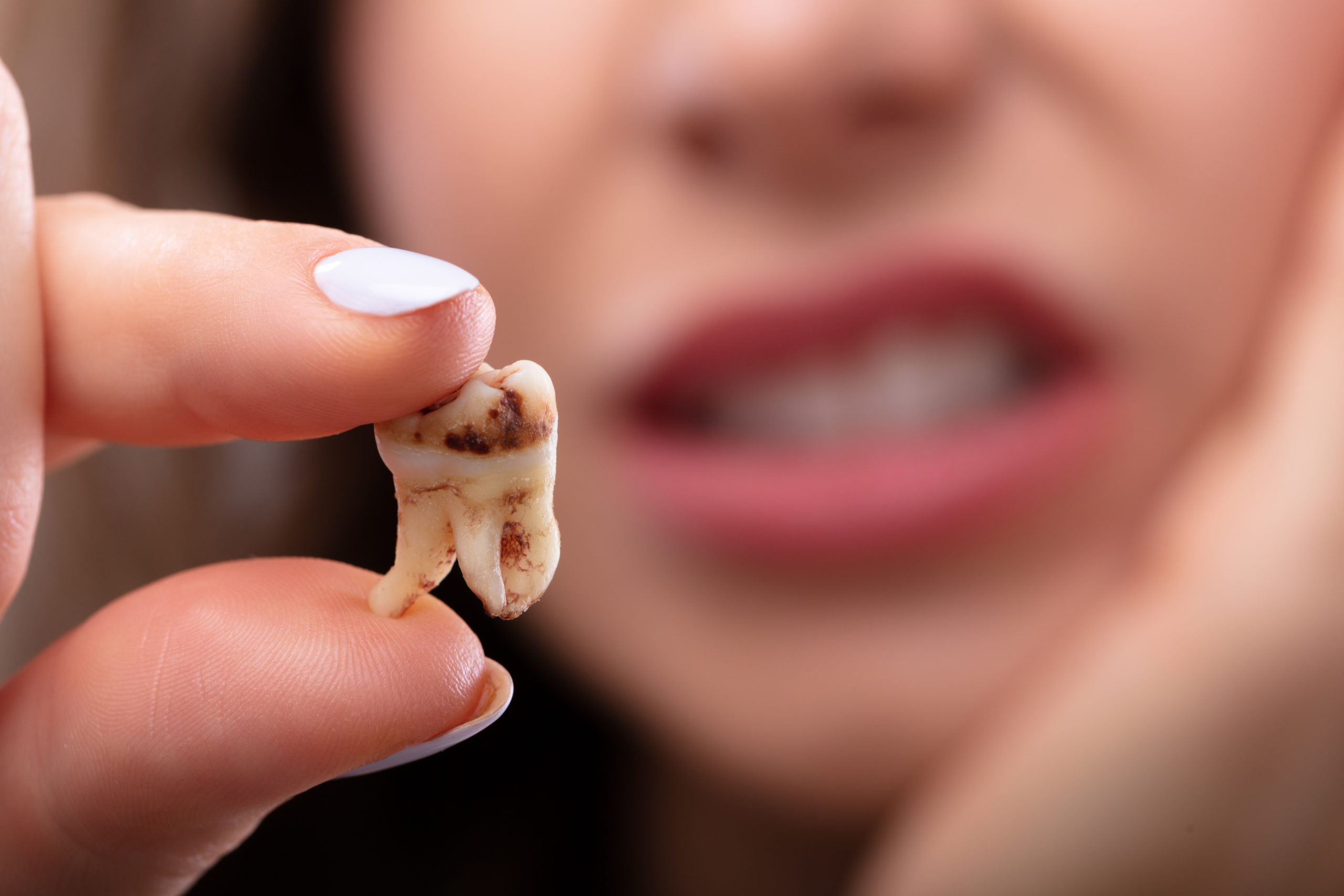 What Is The Leading Cause of Tooth Decay? Artistic Touch Dentistry