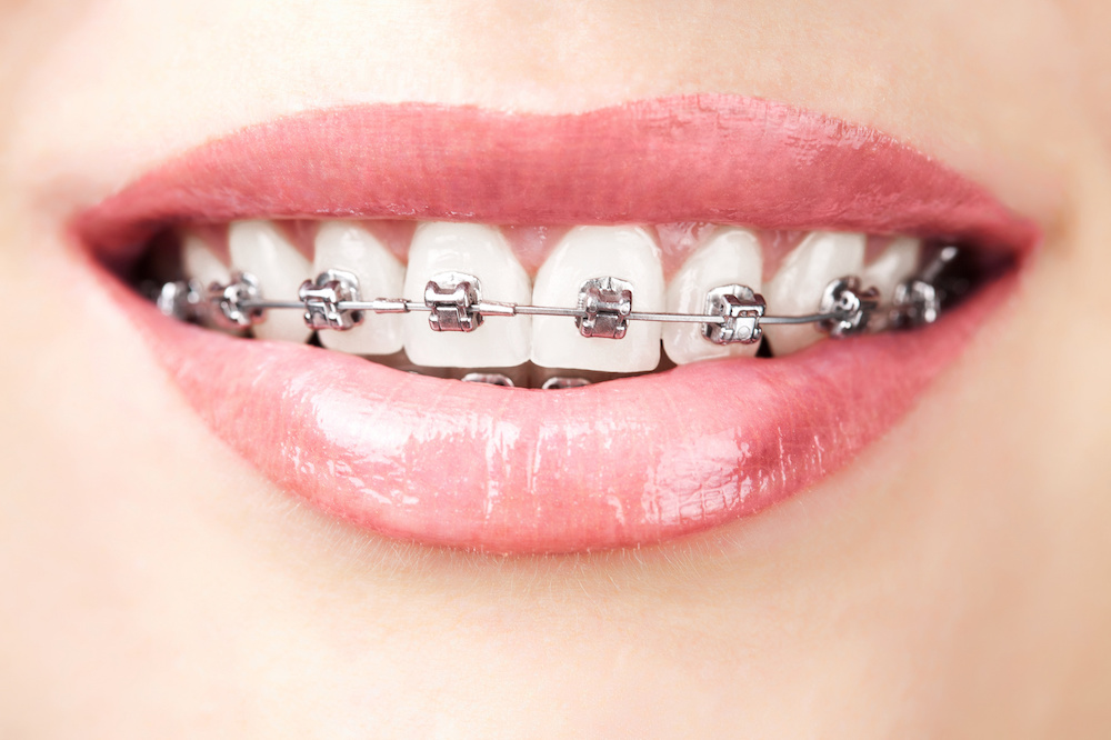 Bruxism and Your Braces Melbourne Orthodontics