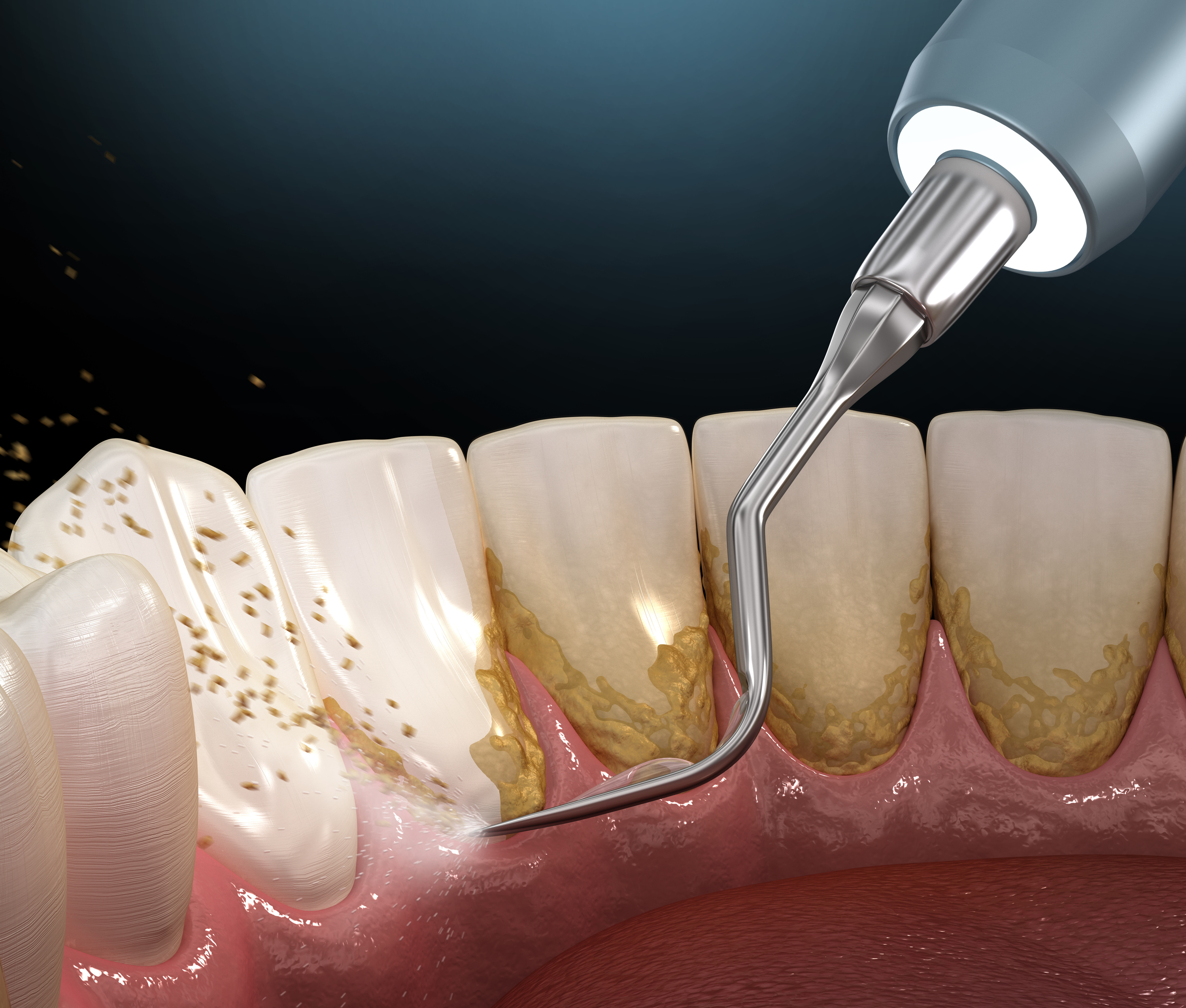 Plaque and Tartar What is the difference? Melbourne Orthodontics