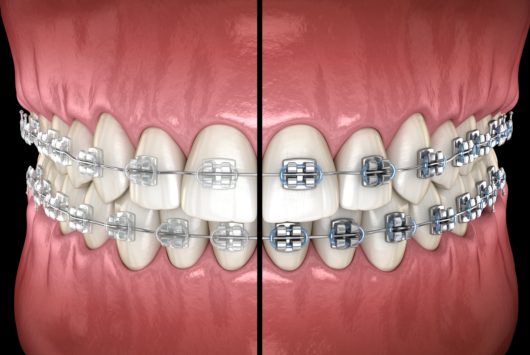 Ceramic or Metal Braces Which Should I Choose? Melbourne Orthodontics