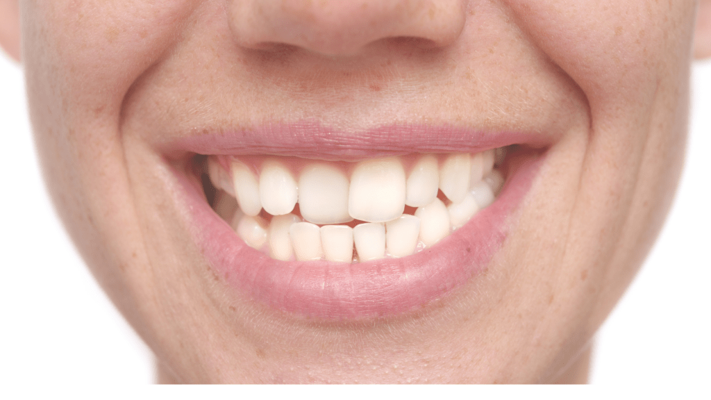 Why Do Teeth Shift After Braces? BuildASmile