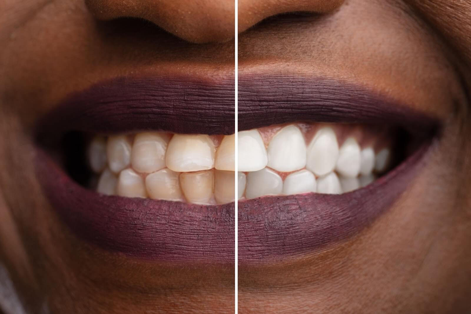 Affordable Teeth Whitening in Charlotte BuildASmile