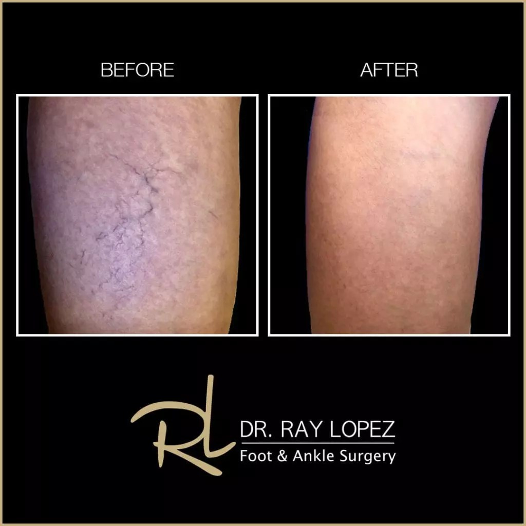 Laser Treatment For Spider Vein Miami Dr. Ray Lopez