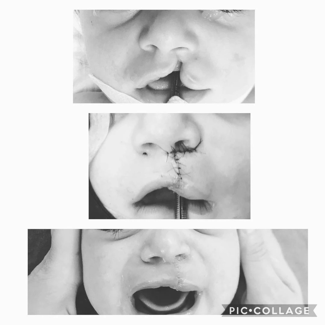 Cleft Lip & Palate Surgery in Turkey MD. Burak Sercan Erçin