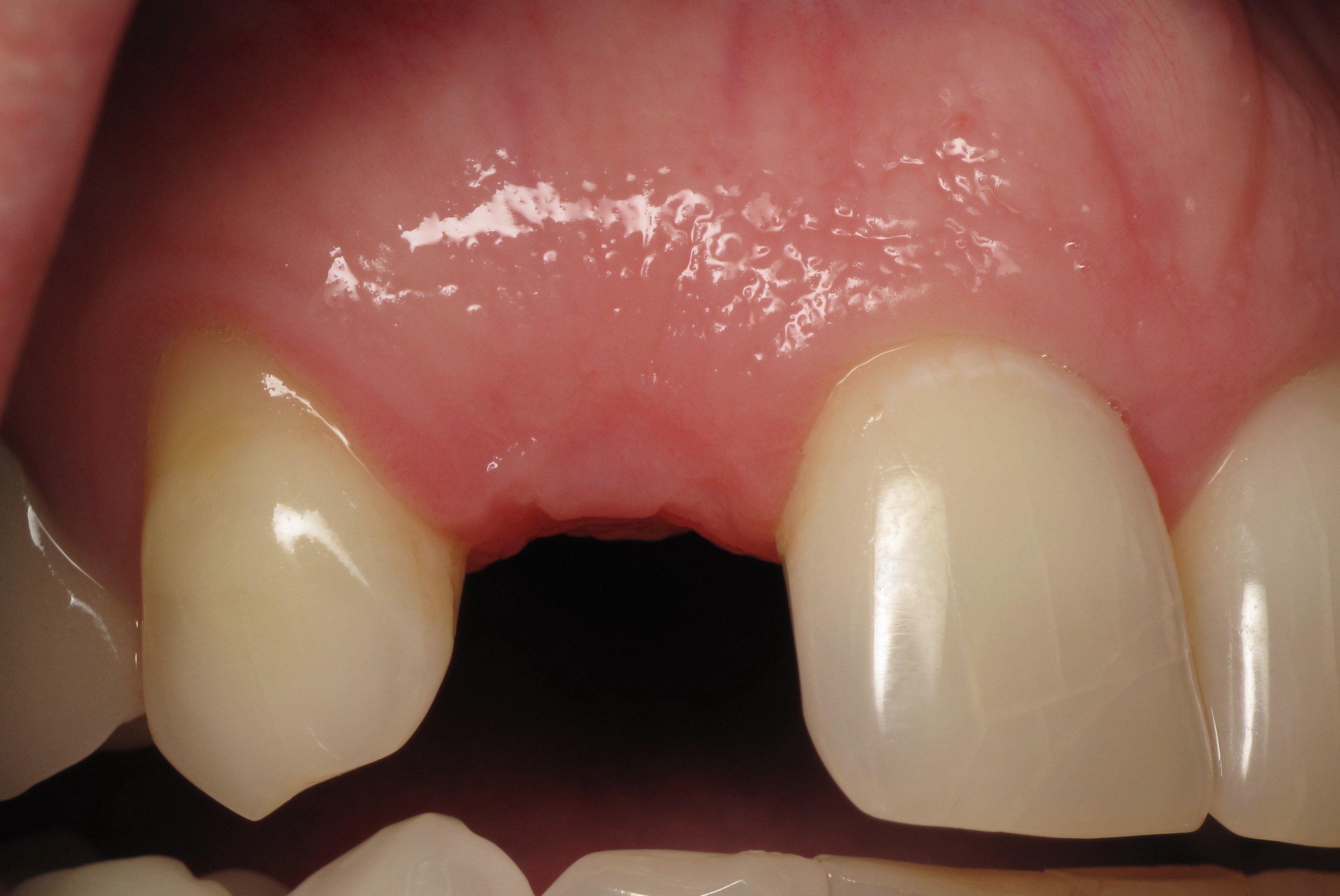 Shaping And Forming Gum Around Front Teeth Dental Implants Ramsey