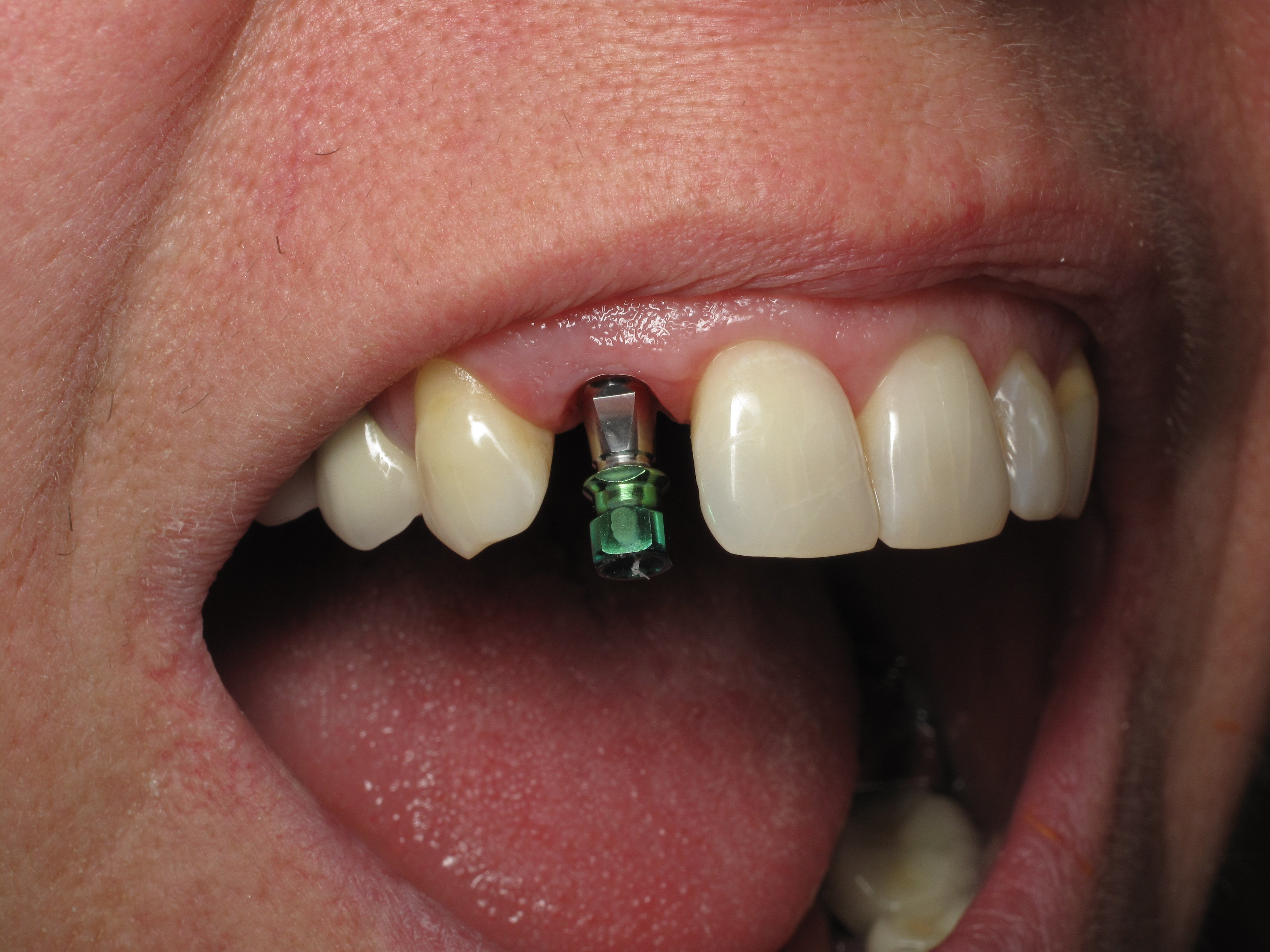 Shaping And Forming Gum Around Front Teeth Dental Implants Ramsey