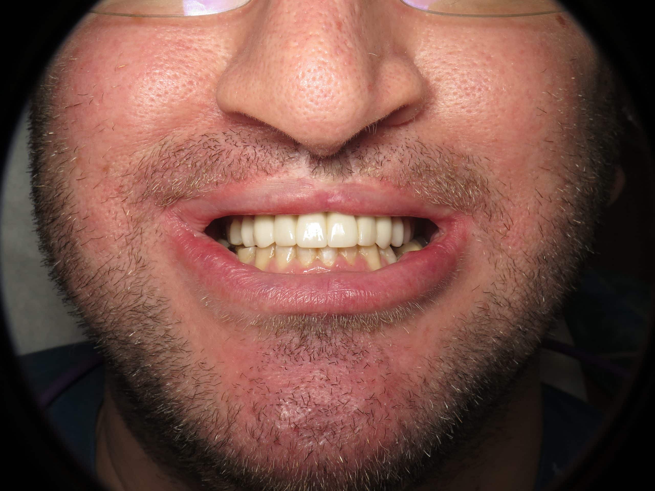 Cleft Lip Palate Dental Implants