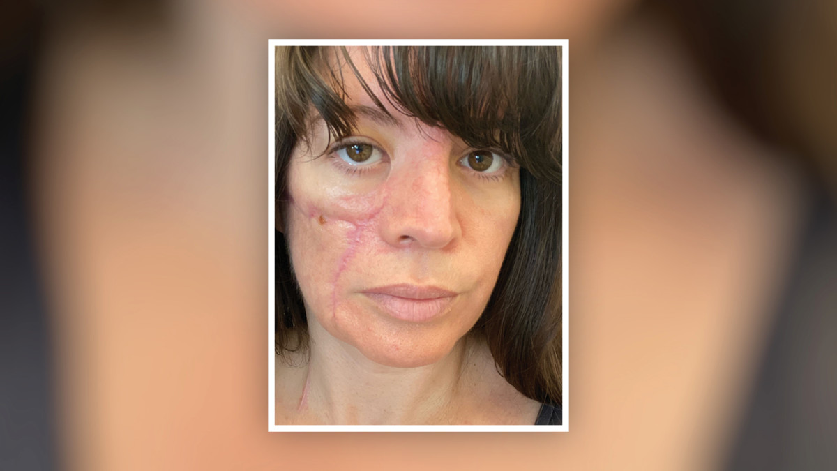 Burn and Reconstructive Centers of America reconstruct the cheek of a