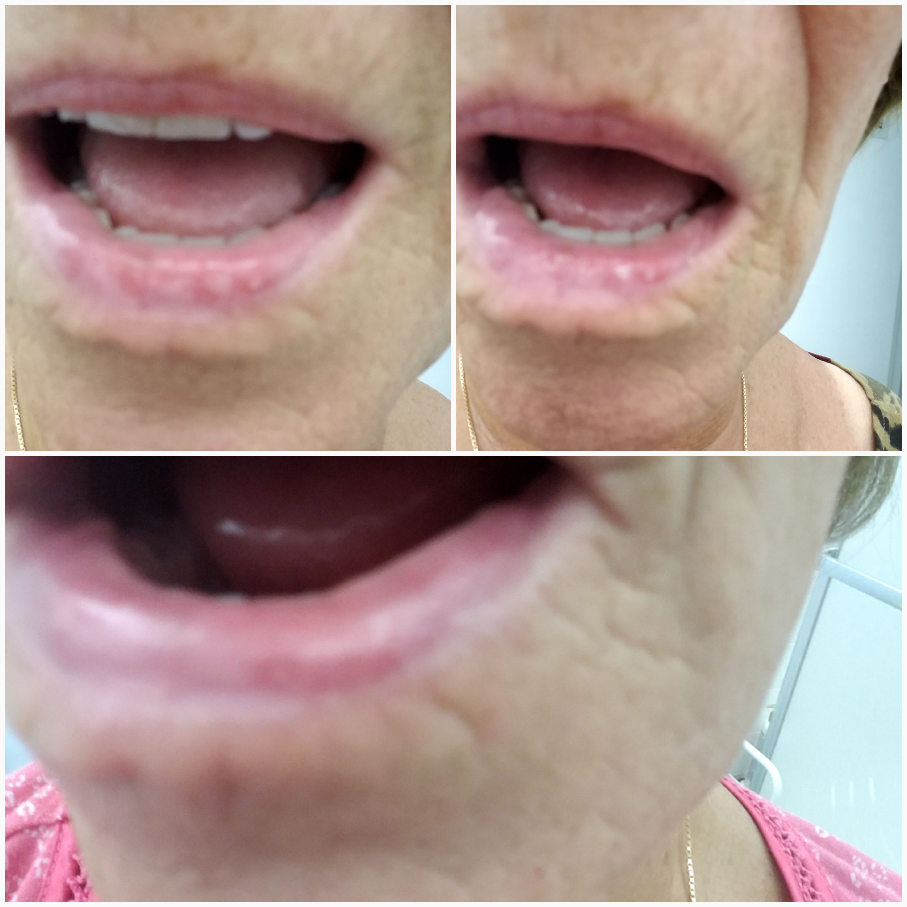Lip Biopsy Pain Burn Solution Foundation