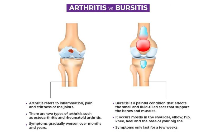 Difference Between Arthritis And Bursitis?