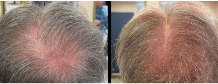 PRP Hair Treatment Naperville PRP Therapy for Hair Loss Morris IL