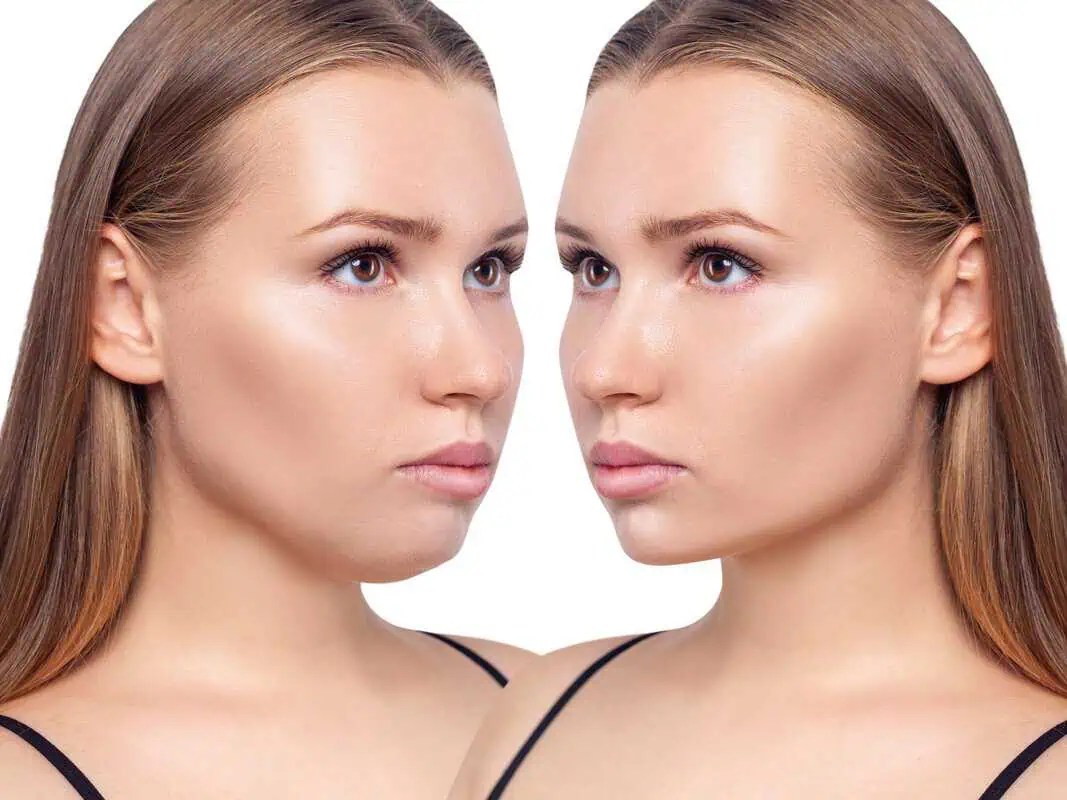 How Much Does Kybella Injection Cost for Double Chin? Butterfly