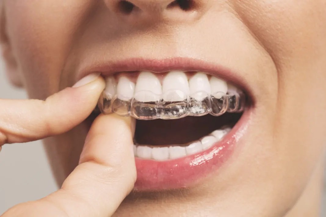 How Long Does Invisalign Take To Straighten Teeth?