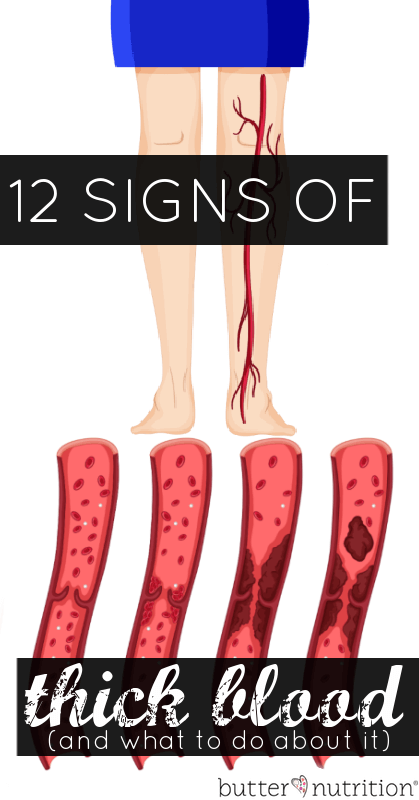 12 Signs of Hypercoagulation (thick, sticky blood that is prone to ...
