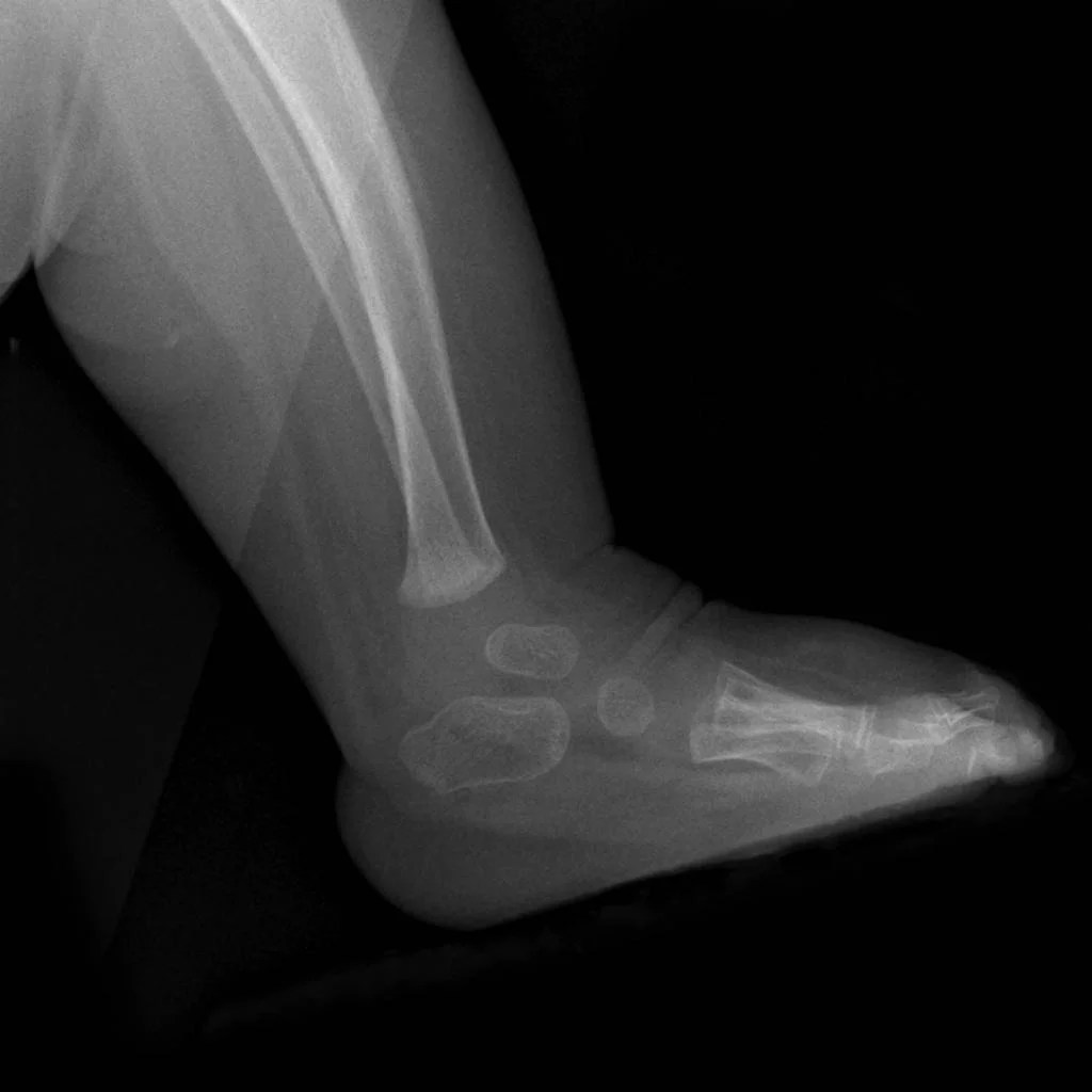 CLUB FOOT