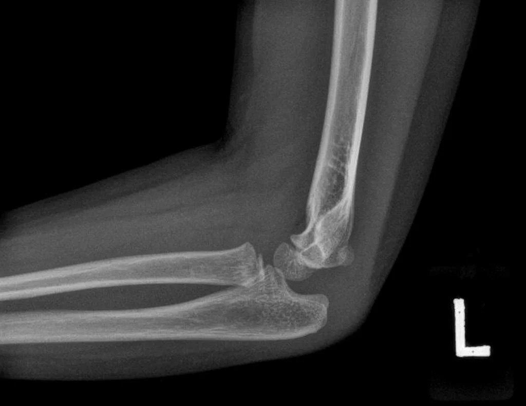 ELBOW JOINT EFFUSION