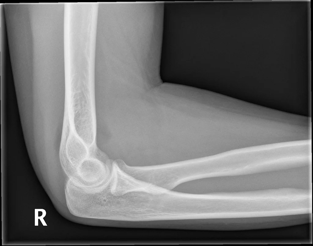 ELBOW JOINT EFFUSION