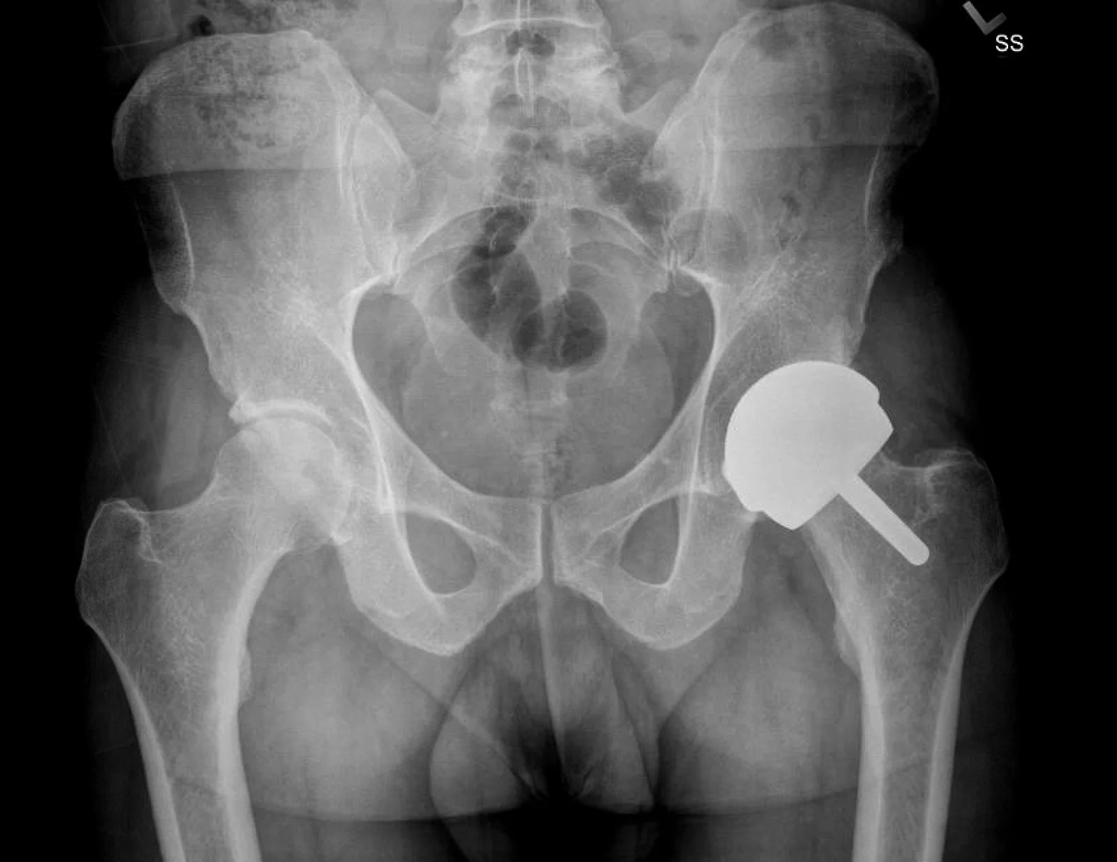 HIP XRAY AFTER RESURFACING