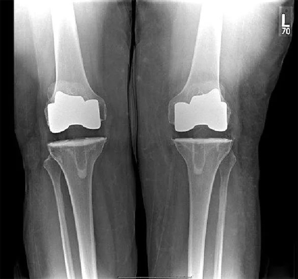 Prosthetic Knees Physiopedia
