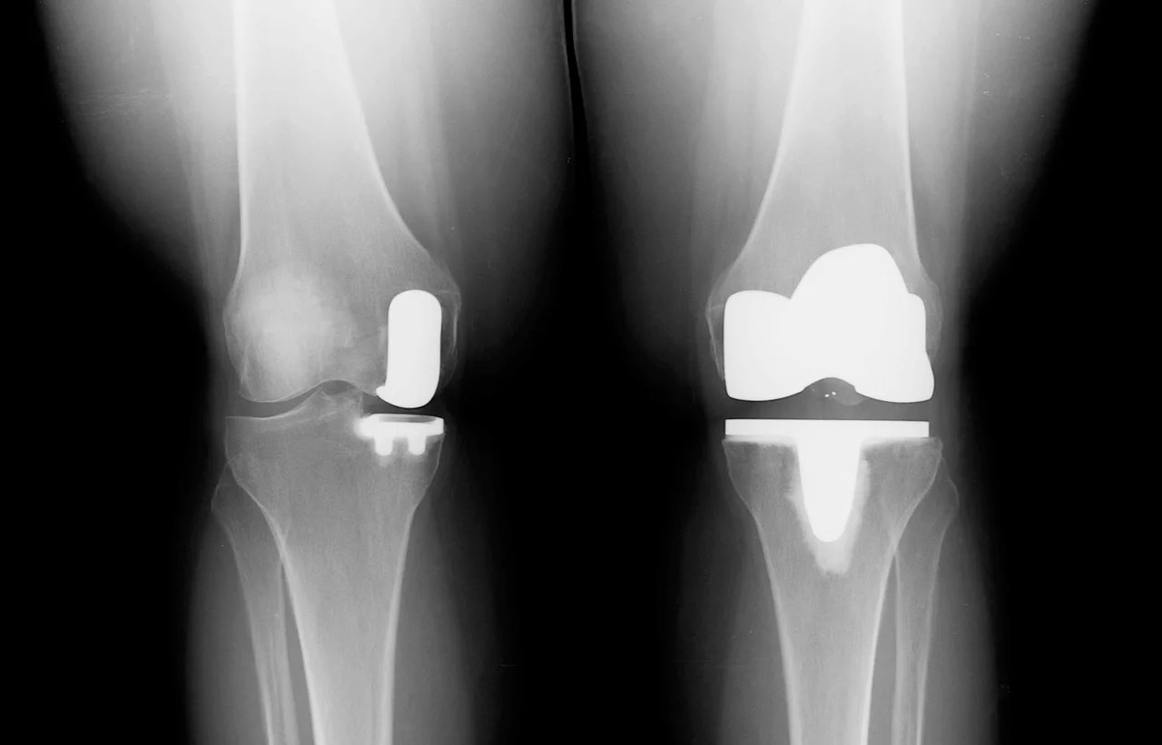 KNEE REPLACEMENT5
